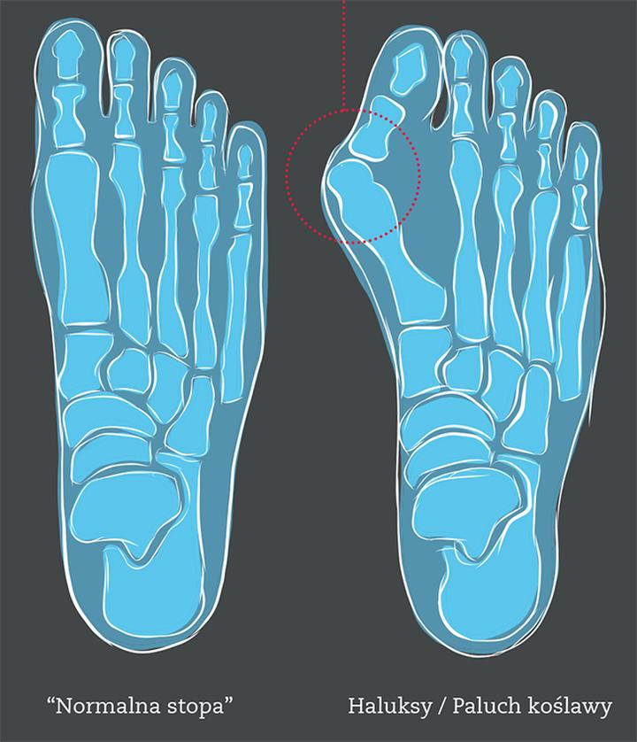 Buty na haluksy do codziennego użytku