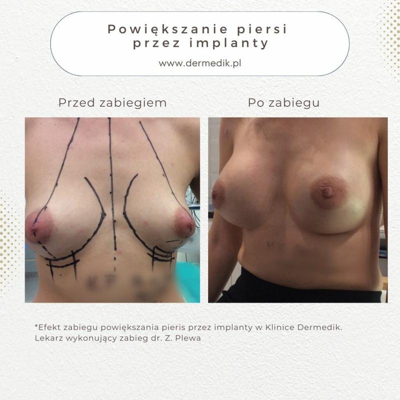 Implanty piersi 320 ml