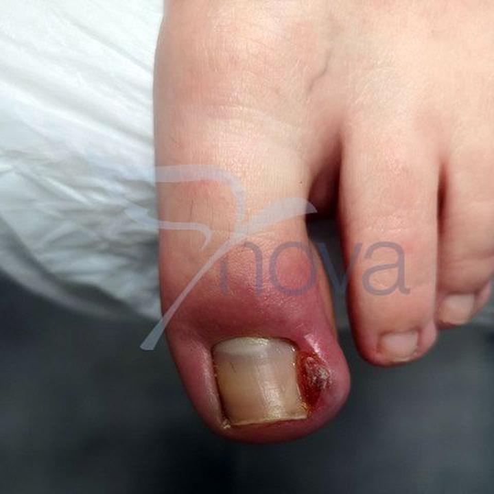 Ból i dyskomfort paznokcia