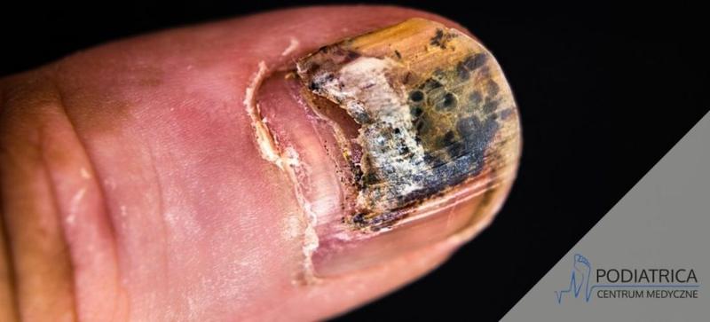 Utrata paznokcia objawy i przyczyny
