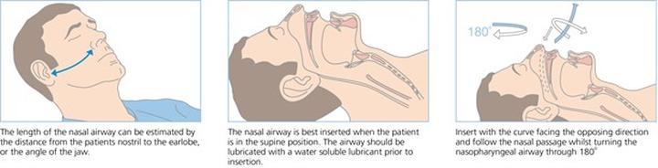 Jak w prosty sposób dobrać rozmiar rurki nosowo-gardłowej?